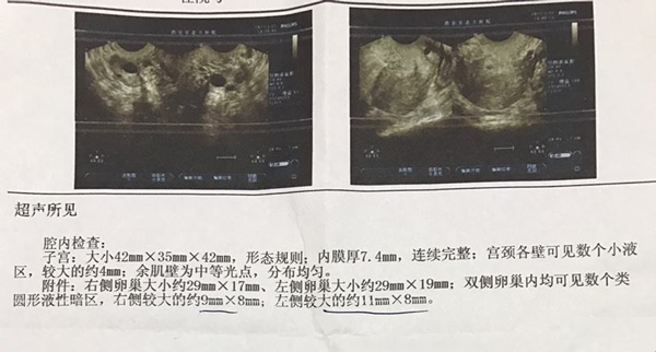 B超监测排卵